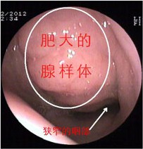 腺样体肥大图片