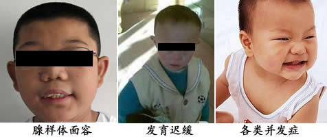 腺样体肥大危害