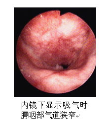 肥大的腺样体阻塞气道