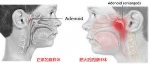 腺样体肥大症状