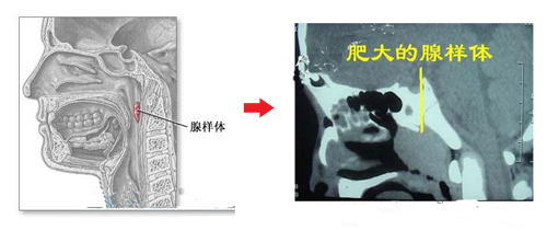 腺样体肥大检查图