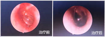 急性中耳炎.jpg