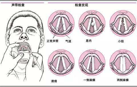 引起声带息肉的主要原因